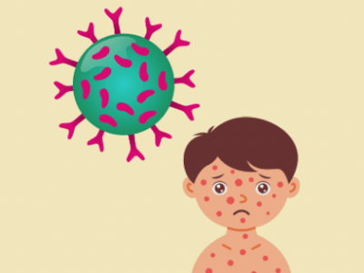 Measles? I barely know&nbsp;her.